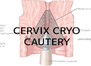 Cosmetic Surgery in Udaipur - cervix cryo cautery