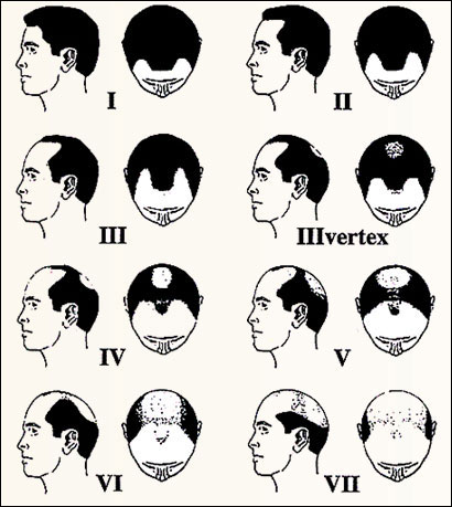 Norwood's Classification of Male Pattern Baldness (Alopecia)