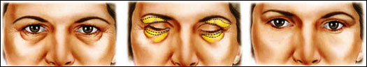 Eyelid Surgery in Udaipur