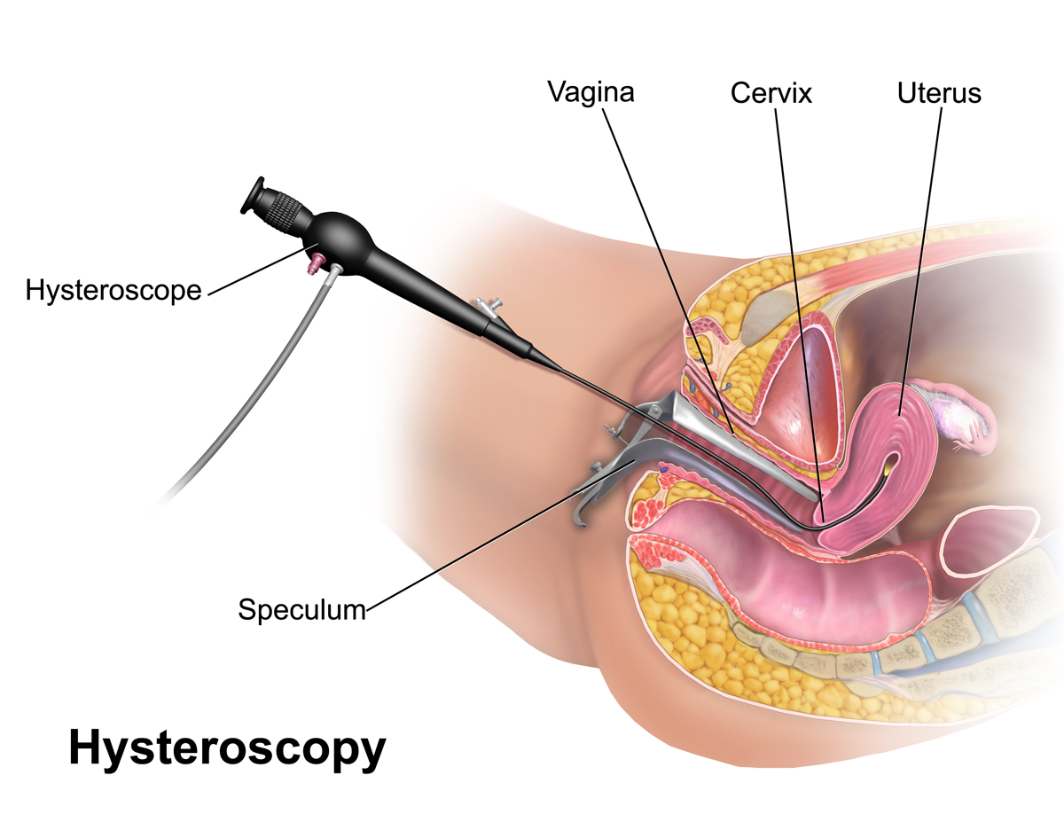 Hysteroscopy Surgery in Udaipur