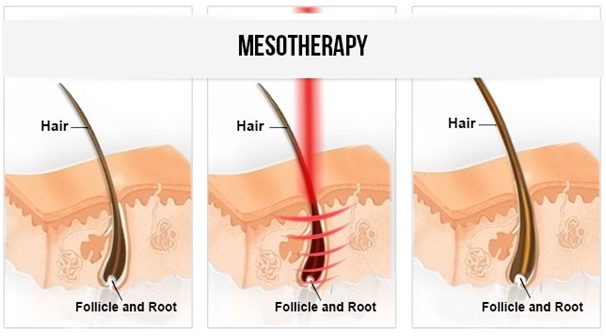 Mesotherapy Hair Treatment in Udaipur - Cosmetic Surgery
