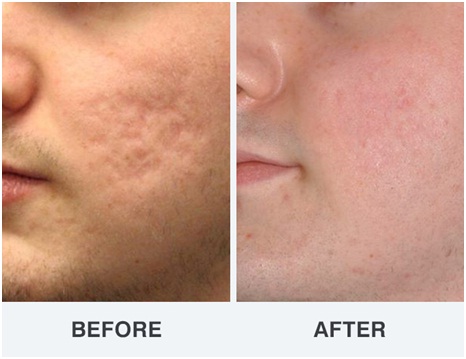 best acne scar treatment - Dermabrasion