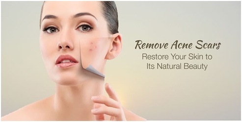 non surgical treatment of acne scars