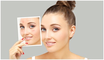 botox for acne scar treatments in Udaipur