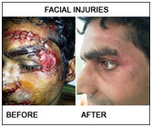 塑料飙升ry in Udaipur - face injuries & face bone fractures
