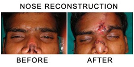 塑料飙升ry in Udaipur - reconstructive surgery