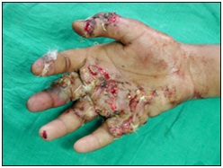 塑料飙升ry in Udaipur - hand & finger injuries